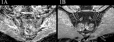 Multi-b-values-fitting readout-segmentation of long variable echo-trains diffusion-weighted imaging (RESOLVE DWI) in evaluation of disease activity and curative effect of axial spondyloarthritis (axSpA)